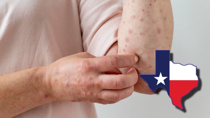 ¿Hay alerta de sarampión en Texas?; esto sabemos al respecto