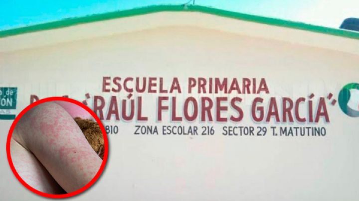 ¿Sarampión o varicela?; esperan resultados por caso en escuela de Tamaulipas