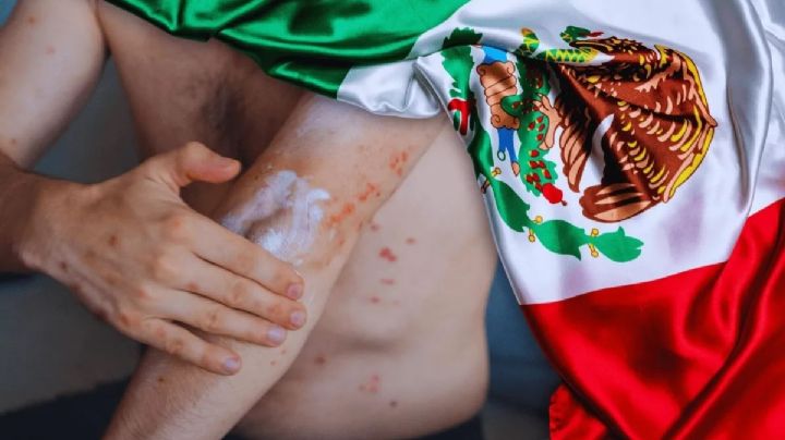 ¿Cuántos contagios de sarampión se han registrado en México desde 2025?