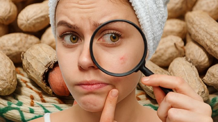 ¿Comer cacahuates provoca espinillas? Esto dicen los expertos