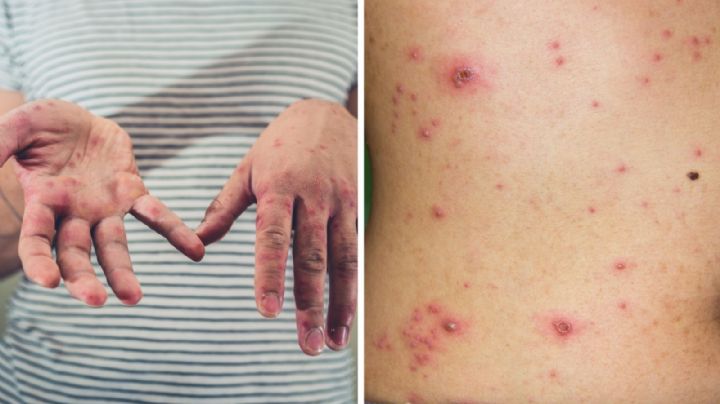 Acecha la varicela a niños de Nuevo Laredo; ¿cómo diferenciarla del sarampión?