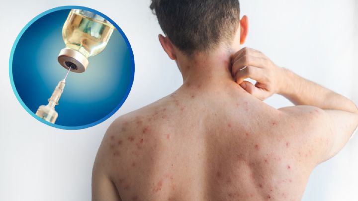 Brote de Sarampión enciende alarmas en Nuevo León; Salud confirma 8 casos y 287 pacientes en análisis