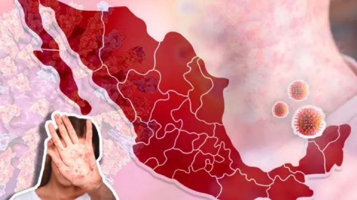 Alerta de Sarampión en México: ¿por qué negarse a vacunar favorece la propagación del virus?