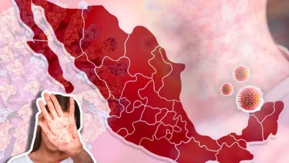 La vacunación contra el sarampión es clave para mantener la inmunidad colectiva