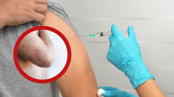 Alerta en Nuevo Laredo por sarampión; no hay casos, pero buscan prevención