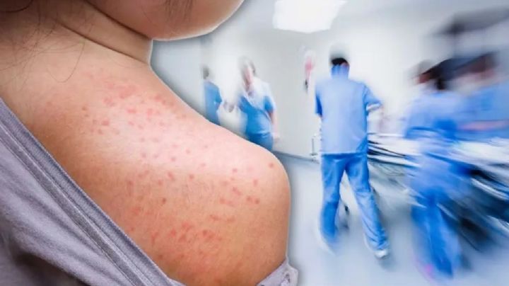 ¿El virus del sarampión sigue vivo en tu mesa? El tiempo exacto que sobrevive en superficies