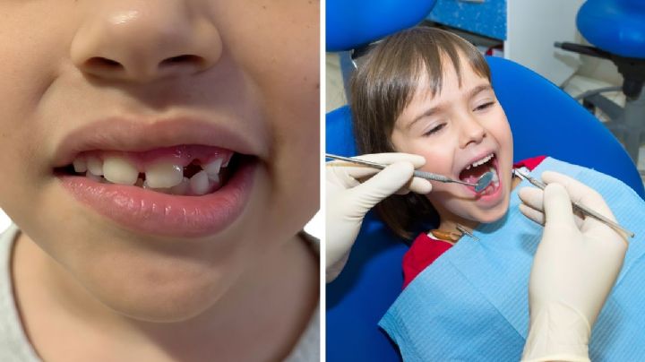 Sufren caries cinco de cada 10 niños en Nuevo Laredo; 7 de 10 presentan gingivitis