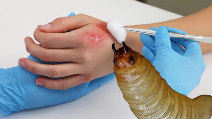 Alertan por casos de miasis en humanos en México; fueron causados por gusano barrenador