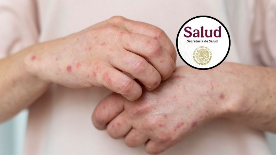 El sarampión es una enfermedad altamente contagiosa que puede causar complicaciones graves e incluso la muerte